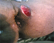 Ksharsutra-procedure